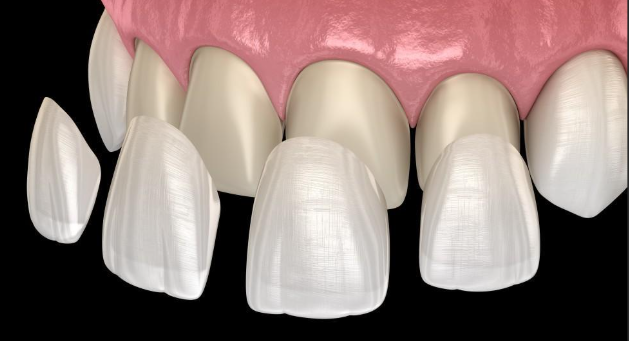 Veneers